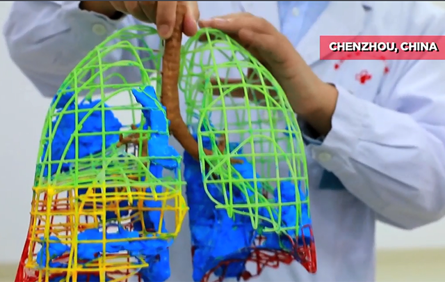 Médicos chinos imprimen modelo 3D del nido de paciente con nuevo coronavirus