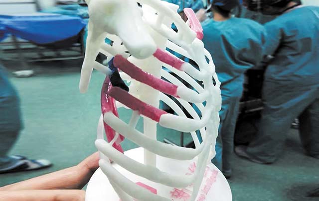 Impresión 3D ayuda a reparar siete costillas